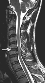 דיסקופתיה צווארית MRI חתך צד