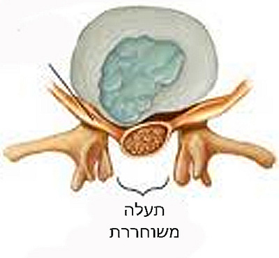 היצרות תעלת עמוד השדרה מותנית Lumbar spinal stenosis