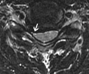 דיסקופתיה צווארית MRI חתך עליון