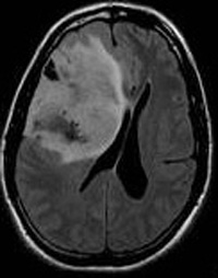 	MRI: מראה את הלחץ המופעל על המוח יחד עם הבצקת סביב הגידול