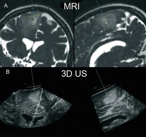 השוואה בין תמונות MRI טרום ניתוחי (שורה עליונה) לבין תמונת אולטראסאונד במהלך הניתוח (שורה תחתונה). המנתח יכול לעקוב בדיוק רב אחר כריתת הגידול ולשמר את הרקמה הבריאה.