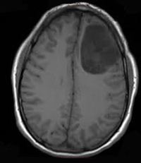 בבדיקת ה-MRI ניתן לזהות בקלות את הגידול בעל אות קהה באזור פרונטלי משמאל.