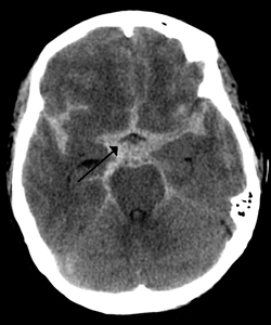 מפרצות של עורקי המוח Cerebral aneurysms