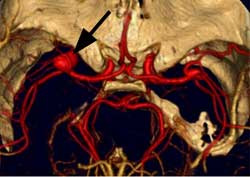 מפרצות של עורקי המוח Cerebral aneurysms
