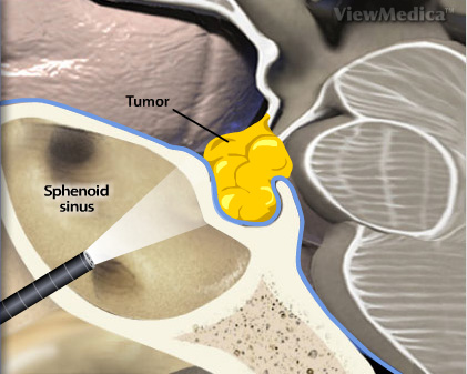 ניתוח טראנס-ספנואידלי לגידול של בלוטת יתר המוח - Transsphenoidal Surgery for Tumor 
