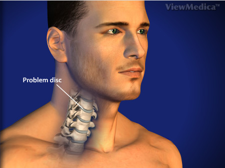 קיבוע קדמי של עמוד שדרה צווארי - Anterior Cervical Discectomy & Fusion