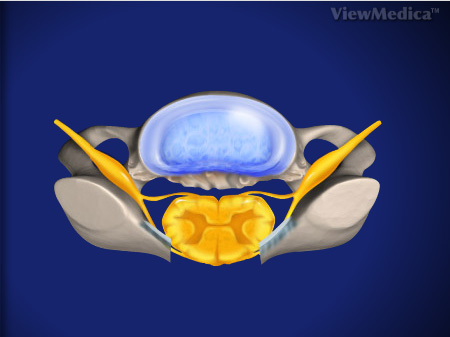קיבוע צווארי אחורי - Laminectomy (Cervical) with Fusion