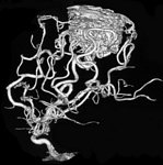 מום עורקי ורידי של המוח Arteriovenous malformation