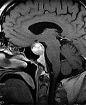אדנומה של בלוטת יתרת המוח Pituitary adenoma
