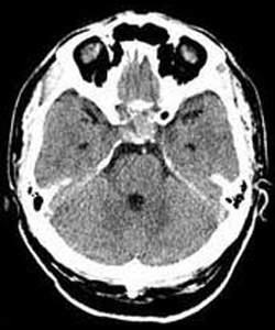 אדנומה של בלוטת יתרת המוח בבדיקת ה-CT