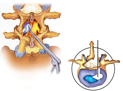 דיסקופתיה מותנית Lumbar disc disease and herniation