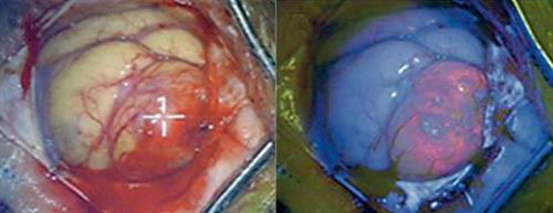 מראה המוח באור רגיל במהלך הניתוח (צד ימין) ולאחר חשיפת אור מיוחד ומתן תרופה הצובעת את רקמת הגידול הצבע אדום זוהר (צד שמאל).