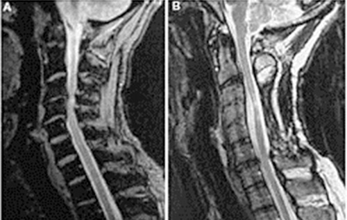 היצרות ספונדילוטית של תעלת עמוד השדרה הצווארי Cervical spondylotic myelopathy