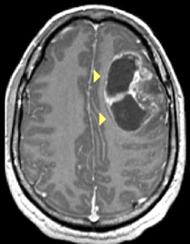 אוליגודנדרוגליומה עם ציסטה והסתיידויות - ממצאים בבדיקת ה-MRI