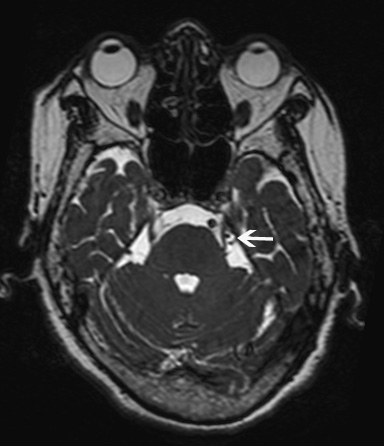 נוירולגיה טריגמינאלית בדיקת ה-MRI