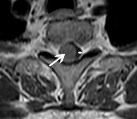 מנינגיומות של עמוד השדרה Spinal meningiomas