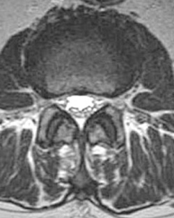 היצרות תעלת עמוד השדרה מותנית Lumbar spinal stenosis