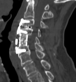 היצרות ספונדילוטית של תעלת עמוד השדרה הצווארי 3