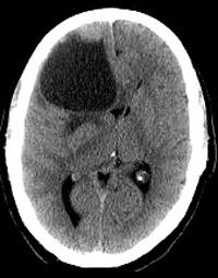 CT: ניתן לראות את הגידול עם סימני לחץ ניכר על המוח