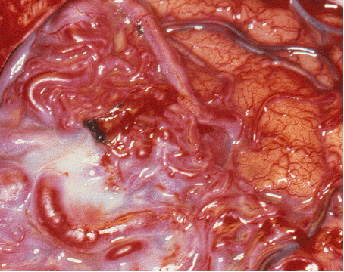 מום עורקי ורידי של המוח Arteriovenous malformation