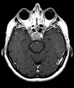 אדנומה של בלוטת יתרת המוח או היפופיזה בבדיקת ה-MRI