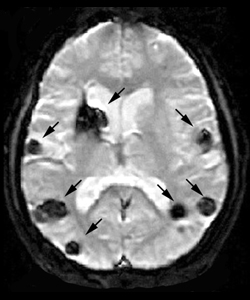 מום מחילתי Cavernous hemangiomas/Cavernomas