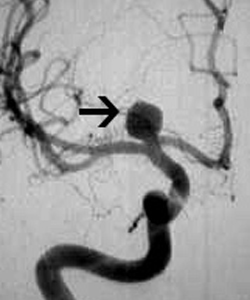 מפרצות של עורקי המוח Cerebral aneurysms
