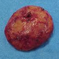 מום מחילתי Cavernous hemangiomas/Cavernomas