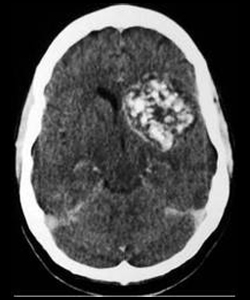 מום מחילתי Cavernous hemangiomas/Cavernomas