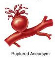 מפרצות של עורקי המוח Cerebral aneurysms