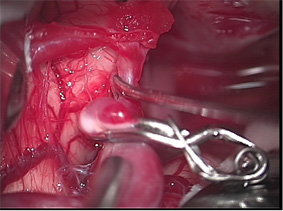 מפרצות של עורקי המוח Cerebral aneurysms
