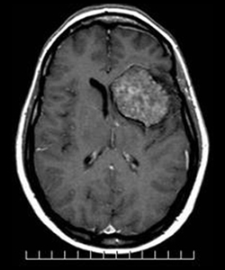 מום מחילתי Cavernous hemangiomas/Cavernomas