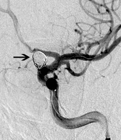 מפרצות של עורקי המוח Cerebral aneurysms