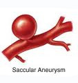 מפרצות של עורקי המוח Cerebral aneurysms