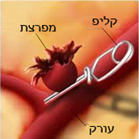 מפרצות של עורקי המוח Cerebral aneurysms